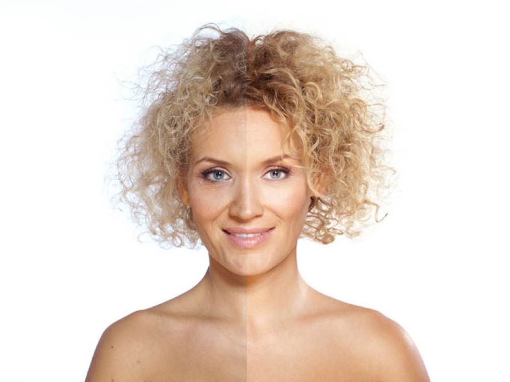 Acne scar treatment results